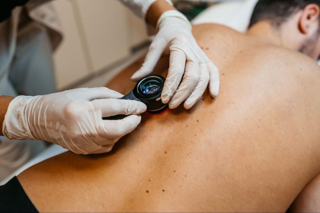 Inmunoterapia y diagnóstico precoz, claves contra el melanoma