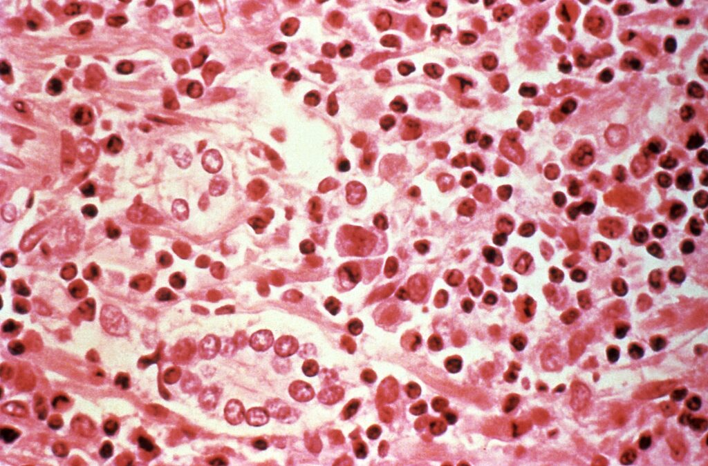 ¿Qué es el hantavirus y qué se sabe de la infección en el crucero que viaja desde Argentina?